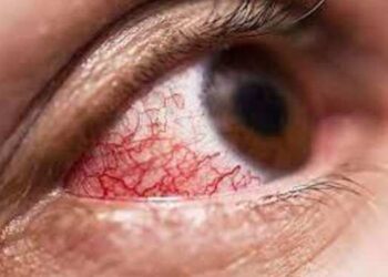 म्युकरमायकोसीस